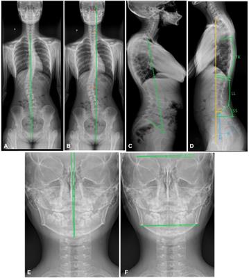 Trunk balance, head posture and plantar pressure in adolescent idiopathic scoliosis